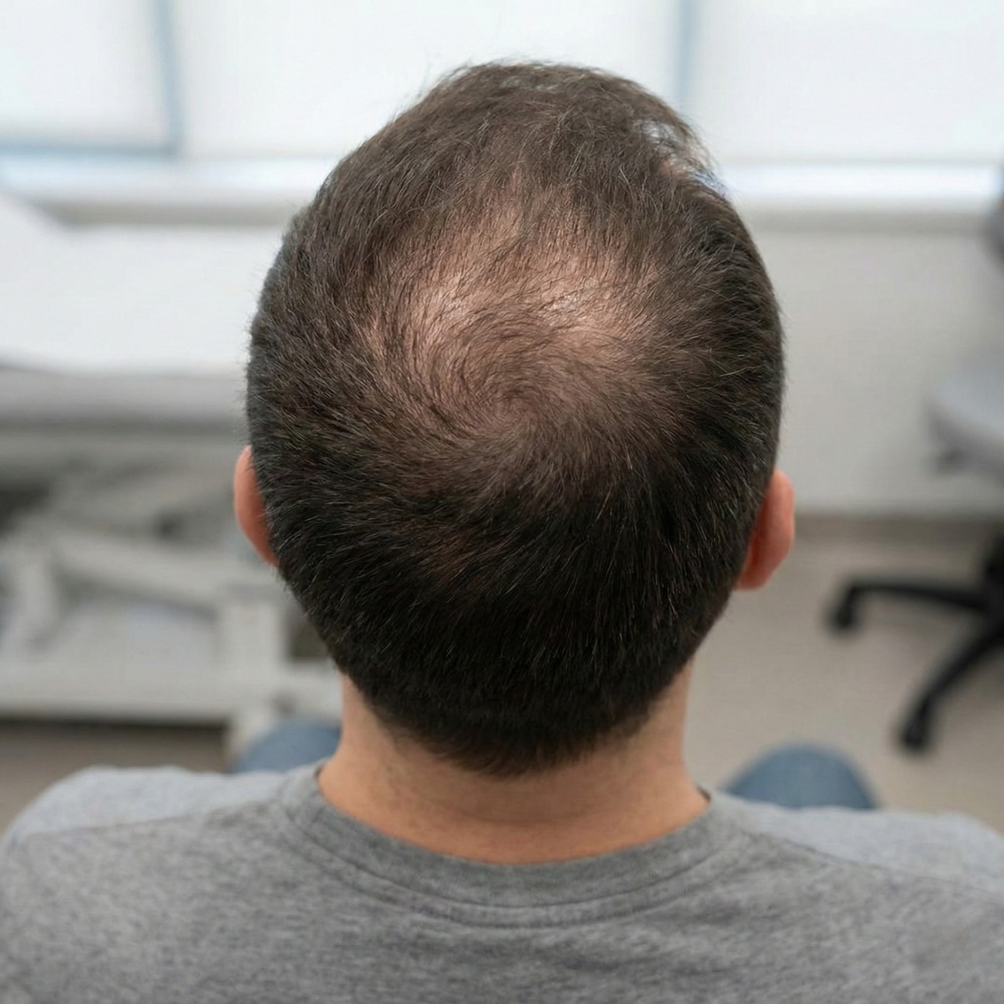 Hombre con adelgazamiento gradual del cabello en la coronilla
