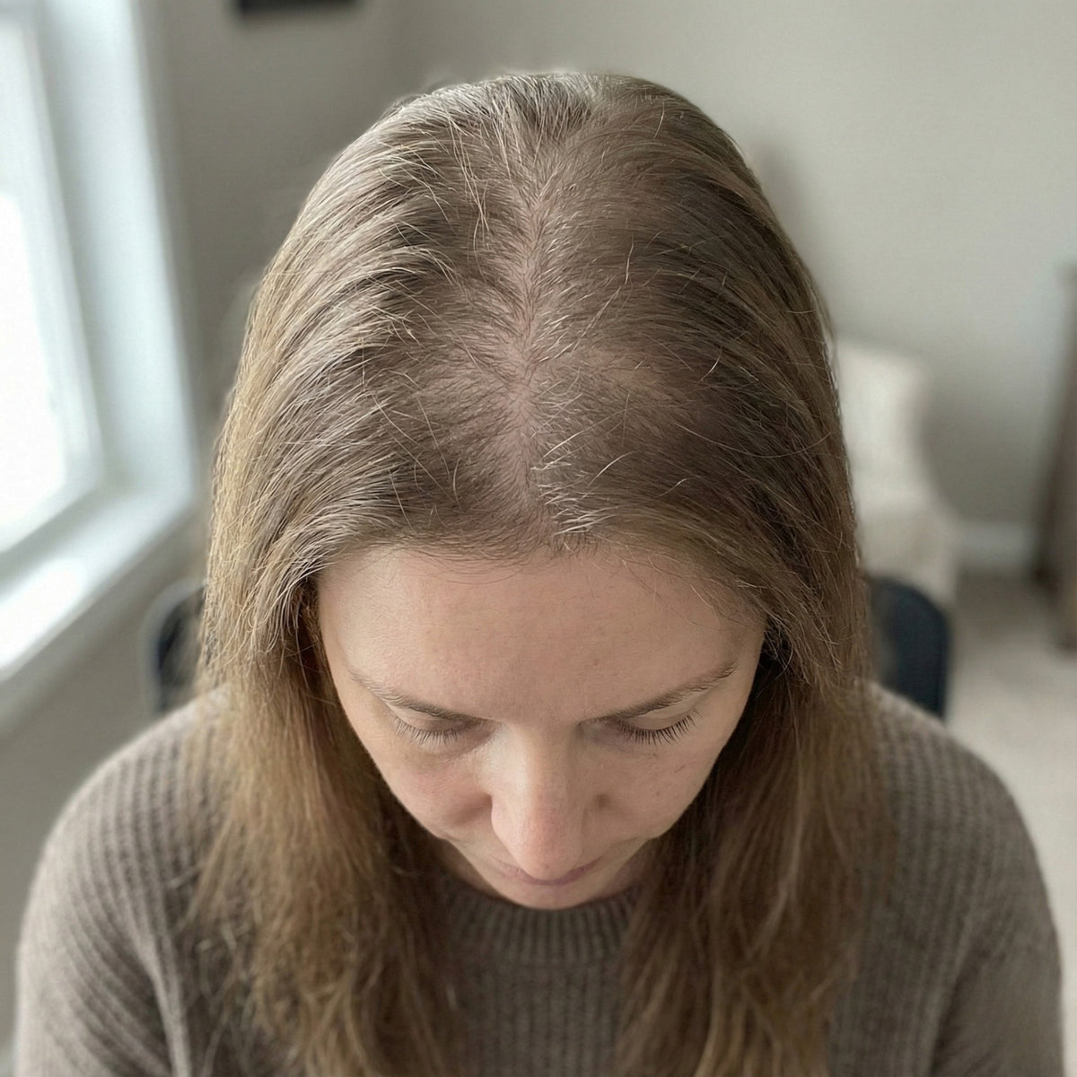Alopecia difusa en mujeres